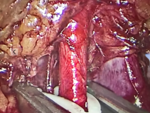 cirugia laparoscopica leon